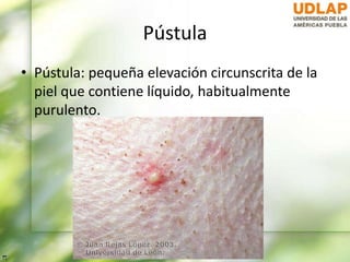 Pústula
• Pústula: pequeña elevación circunscrita de la
piel que contiene líquido, habitualmente
purulento.
 