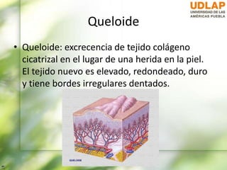 Queloide
• Queloide: excrecencia de tejido colágeno
cicatrizal en el lugar de una herida en la piel.
El tejido nuevo es elevado, redondeado, duro
y tiene bordes irregulares dentados.
 