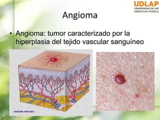 Angioma
• Angioma: tumor caracterizado por la
hiperplasia del tejido vascular sanguíneo
 