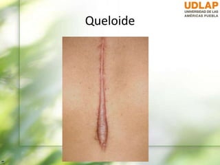 Queloide
 