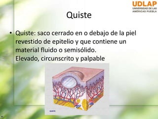 Quiste
• Quiste: saco cerrado en o debajo de la piel
revestido de epitelio y que contiene un
material fluido o semisólido.
Elevado, circunscrito y palpable
 