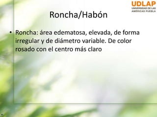 Roncha/Habón
• Roncha: área edematosa, elevada, de forma
irregular y de diámetro variable. De color
rosado con el centro más claro
 