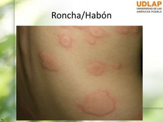 Roncha/Habón
 