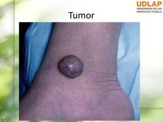 Tumor
 