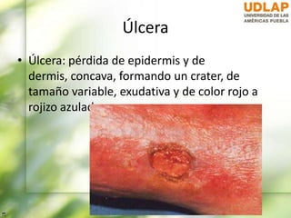 Úlcera
• Úlcera: pérdida de epidermis y de
dermis, concava, formando un crater, de
tamaño variable, exudativa y de color rojo a
rojizo azulado
 