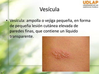 Vesícula
• Vesícula: ampolla o vejiga pequeña, en forma
de pequeña lesión cutánea elevada de
paredes finas, que contiene un líquido
transparente.
 