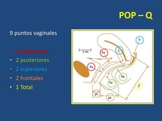 POP – Q
9 puntos vaginales
•
•
•
•
•

2 anteriores
2 posteriores
2 superiores
2 frontales
1 Total

 