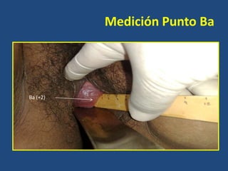 Medición Punto Ba

Ba (+2)

 