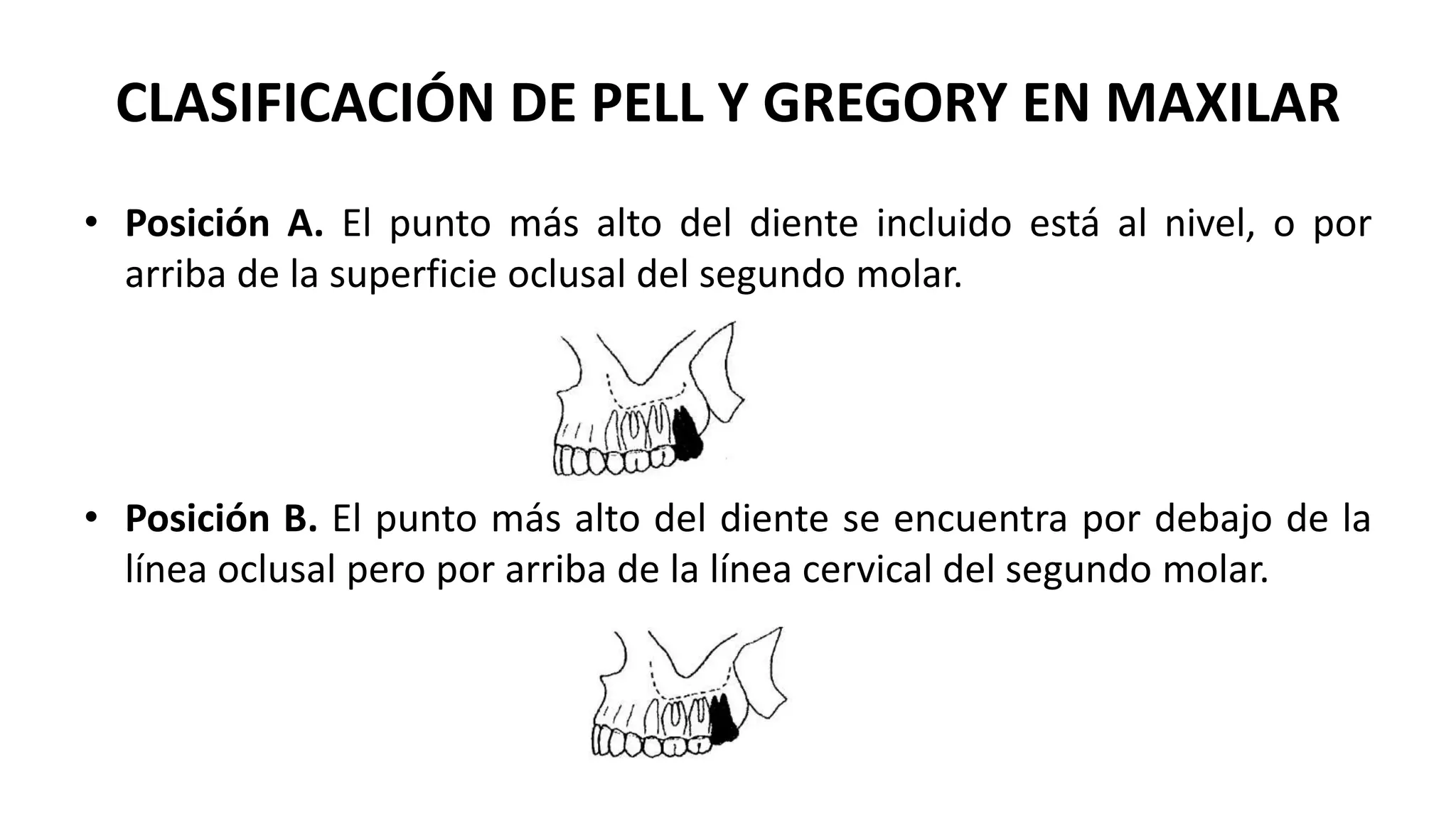 Clasificación terceros molares.pptx