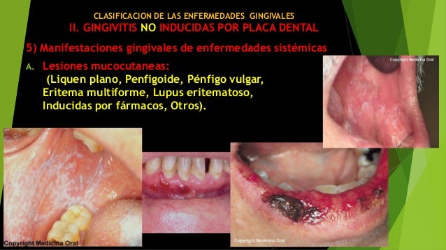 Clasificacion de las enfermedades gingivales y periodontale