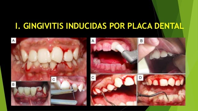 Clasificacion de las enfermedades gingivales y periodontale