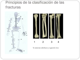 Principios de la clasificación de las
fracturas
Se numeran cada hueso y segmento óseo
1 2 3 4
 