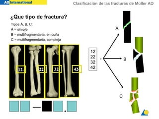 Clasificación de las fracturas de Müller AO
12- 22-22- 32-32- 42-42-
12
22
32
42
-
A
B
C
— .
¿Que tipo de fractura?
Tipos A, B, C:
A = simple
B = multifragmentaria, en cuña
C = multifragmentaria, compleja
 