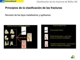 Clasificación de las fracturas de Müller AO
Revisión de los tipos metafisarios y epifisarios
21
13 33
41
23
43
A
B
C
Which types of fracture? metaphyseal or epiphyseal Metaphyseal/epiphyseal types
A
B
C
Extra-articular fracture
Partial articular fracture – part of joint
remains in continuity with diaphysis
Complete articular fracture – no part of joint
remains in continuity with diaphysis
Principios de la clasificación de las fracturas
 