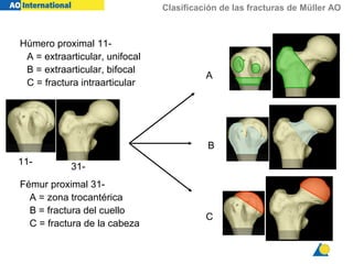 Clasificación de las fracturas de Müller AO
11-
A
C
31-
B
Húmero proximal 11-
A = extraarticular, unifocal
B = extraarticular, bifocal
C = fractura intraarticular
Fémur proximal 31-
A = zona trocantérica
B = fractura del cuello
C = fractura de la cabeza
 