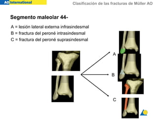 Clasificación de las fracturas de Müller AO
Segmento maleolar 44-
A = lesión lateral externa infrasindesmal
B = fractura del peroné intrasindesmal
C = fractura del peroné suprasindesmal
A
B
C
 