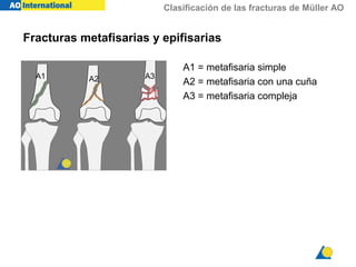 Clasificación de las fracturas de Müller AO
A1 = metafisaria simple
A2 = metafisaria con una cuña
A3 = metafisaria compleja
A1 A2 A3
Fracturas metafisarias y epifisarias
 