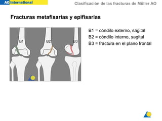 Clasificación de las fracturas de Müller AO
B1 = cóndilo externo, sagital
B2 = cóndilo interno, sagital
B3 = fractura en el plano frontal
B1 B2 B3
Fracturas metafisarias y epifisarias
 