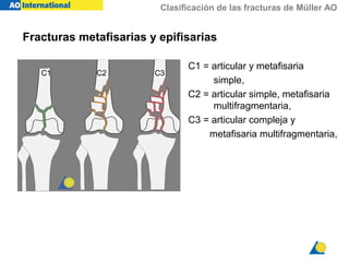 Clasificación de las fracturas de Müller AO
C1 = articular y metafisaria
simple,
C2 = articular simple, metafisaria
multifragmentaria,
C3 = articular compleja y
metafisaria multifragmentaria,
C1 C2 C3
Fracturas metafisarias y epifisarias
 