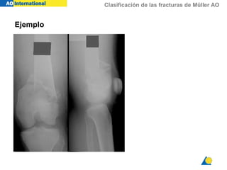 Clasificación de las fracturas de Müller AO
Ejemplo
 
