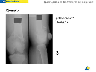Clasificación de las fracturas de Müller AO
¿Clasificación?
Hueso = 3
3
Ejemplo
 
