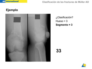 Clasificación de las fracturas de Müller AO
¿Clasificación?
Hueso = 3
Segmento = 3
33
Ejemplo
 