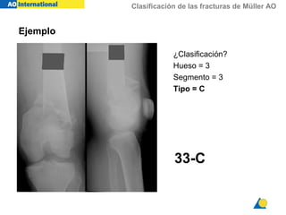 Clasificación de las fracturas de Müller AO
33-C
Ejemplo
¿Clasificación?
Hueso = 3
Segmento = 3
Tipo = C
 