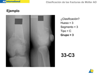 Clasificación de las fracturas de Müller AO
33-C3
Ejemplo
¿Clasificación?
Hueso = 3
Segmento = 3
Tipo = C
Grupo = 3
 
