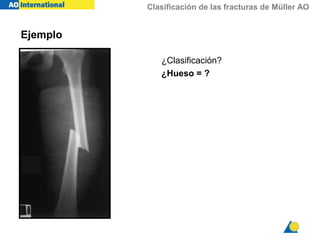 Clasificación de las fracturas de Müller AO
¿Clasificación?
¿Hueso = ?
Ejemplo
 