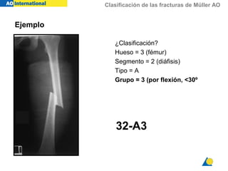 Clasificación de las fracturas de Müller AO
32-A3
Ejemplo
¿Clasificación?
Hueso = 3 (fémur)
Segmento = 2 (diáfisis)
Tipo = A
Grupo = 3 (por flexión, <30º
 