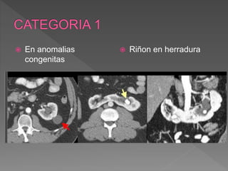  En anomalias
congenitas
 Riñon en herradura
 