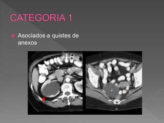  Asociados a quistes de
anexos
 