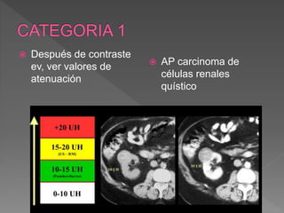  Después de contraste
ev, ver valores de
atenuación
 AP carcinoma de
células renales
quístico
 