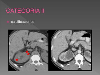  calcificaciones
 