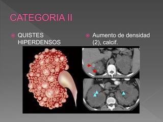  QUISTES
HIPERDENSOS
 Aumento de densidad
(2), calcif.
 
