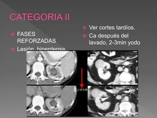  FASES
REFORZADAS
 Lesión hiperdensa
 Ver cortes tardíos.
 Ca después del
lavado, 2-3min yodo
 