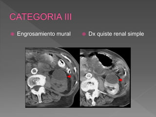  Engrosamiento mural  Dx quiste renal simple
 