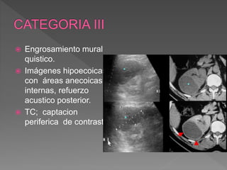  Engrosamiento mural
quistico.
 Imágenes hipoecoicas
con áreas anecoicas
internas, refuerzo
acustico posterior.
 TC; captacion
periferica de contraste
 