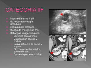  Intermedia entre II yIII
 No necesitan cirugía
inmediata
 Seguimiento estrecho
 Riesgo de malignidad 5%
 Hallazgos imagenologicos:
› Múltiples septos finos
› Calcificación gruesa y
nodular
› Suave refuerzo de pared y
septos
› Sin componentes solidos
que refuerzen.
› Quistes hiperdensos >3cm
 