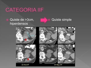  Quiste de >3cm,
hiperdensos
 Quiste simple
 