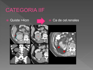  Quiste >4cm  Ca de cel.renales
 
