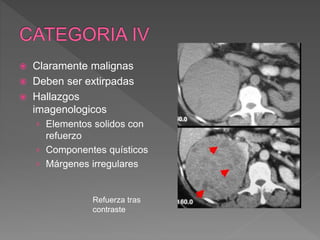  Claramente malignas
 Deben ser extirpadas
 Hallazgos
imagenologicos
› Elementos solidos con
refuerzo
› Componentes quísticos
› Márgenes irregulares
Refuerza tras
contraste
 