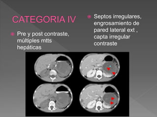  Pre y post contraste,
múltiples mtts
hepáticas
 Septos irregulares,
engrosamiento de
pared lateral ext ,
capta irregular
contraste
 