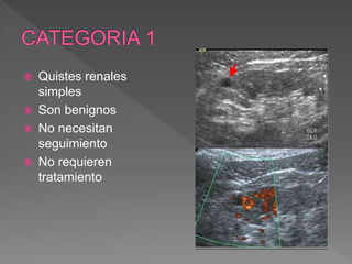  Quistes renales
simples
 Son benignos
 No necesitan
seguimiento
 No requieren
tratamiento
 