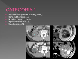  Redondeadas paredes lisas regulares,
 Densidad homogenena
 No refuerzo con contraste
 Hipointensas en RM T1
 Hipertensas en T2
 