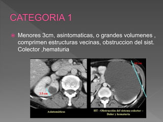  Menores 3cm, asintomaticas, o grandes volumenes ,
comprimen estructuras vecinas, obstruccion del sist.
Colector ,hematuria
 