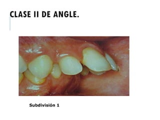 CLASE II DE ANGLE.
Subdivisión 1
 