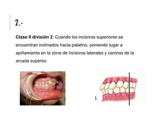 2.-
Clase II división 2: Cuando los incisivos superiores se
encuentran inclinados hacia palatino, poniendo lugar a
apiñamiento en la zona de incisivos laterales y caninos de la
arcada superior.
 