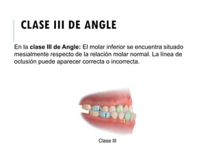 CLASE III DE ANGLE
En la clase III de Angle: El molar inferior se encuentra situado
mesialmente respecto de la relación molar normal. La línea de
oclusión puede aparecer correcta o incorrecta.
 