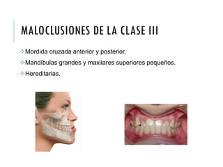 MALOCLUSIONES DE LA CLASE III
Mordida cruzada anterior y posterior.
Mandíbulas grandes y maxilares superiores pequeños.
Hereditarias.
 